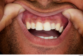 Aaron teeth 0002.jpg